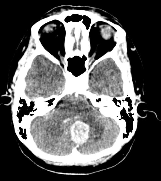 Cerebellar metastases - colorectal adenocarcinoma (Radiopaedia 40947-43652 Axial C+ 12).png
