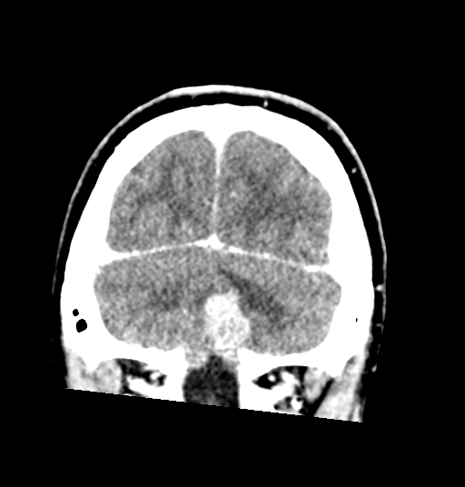 Cerebellar metastases - colorectal adenocarcinoma (Radiopaedia 40947-43652 Coronal C+ 77).png