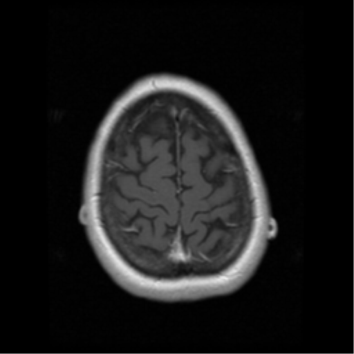File:Cerebellar metastasis (cystic appearance) (Radiopaedia 41395-44262 Axial T1 C+ 19).png