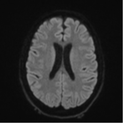 Cerebellar metastasis - adenocarcinoma lung (Radiopaedia 63184-71715 Axial DWI 47).png