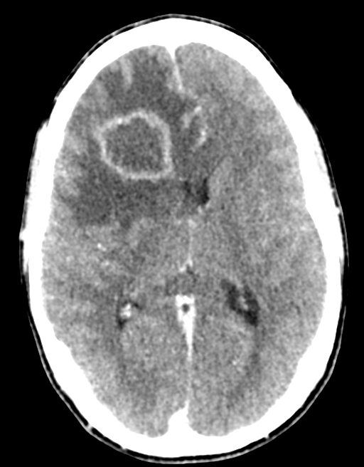 Cerebral abscess (Radiopaedia 60342-68008 Axial C+ delayed 28).png