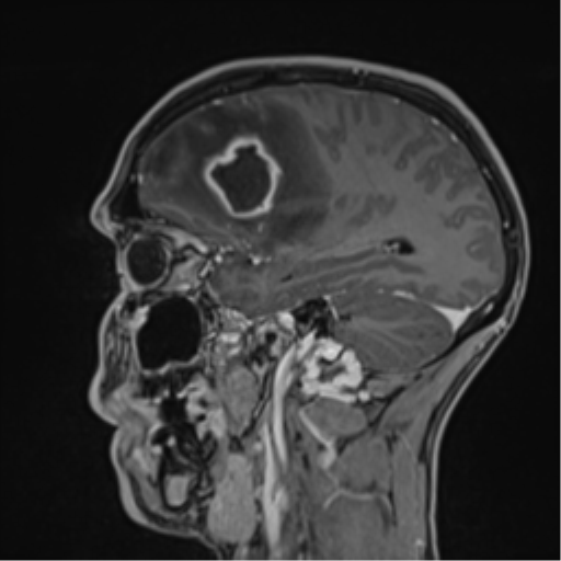 Cerebral abscess (Radiopaedia 60342-68009 J 39).png