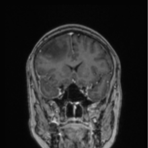 Cerebral abscess from pulmonary arteriovenous malformation (Radiopaedia 86275-102291 L 60).png