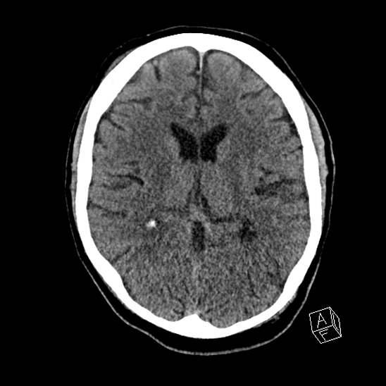 Cerebral abscess with ventriculitis (Radiopaedia 78965-91876 Axial non-contrast 27).jpg
