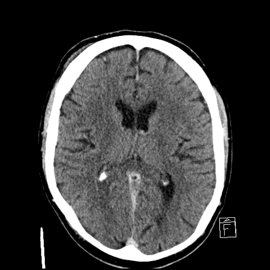 File:Cerebral abscess with ventriculitis (Radiopaedia 78965-91877 A 26).jpg
