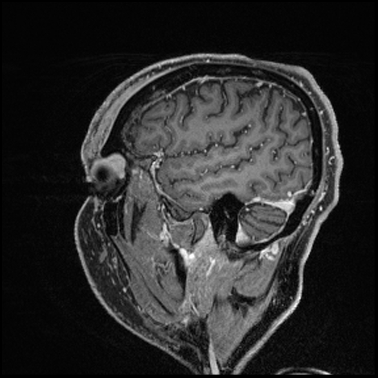 Cerebral abscess with ventriculitis (Radiopaedia 78965-91878 Sagittal T1 C+ 40).jpg