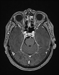Cerebral amyloid angiopathy-related inflammation (Radiopaedia 58270-65377 Axial T1 C+ fat sat 44).jpg