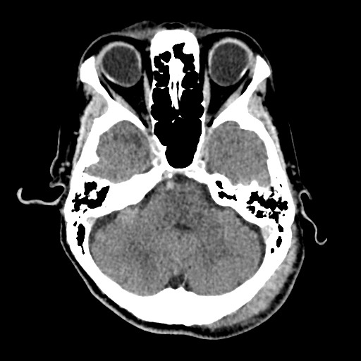 File:Cerebral amyloid angiopathy-related inflammation (Radiopaedia 74836-85848 Axial non-contrast 18).jpg