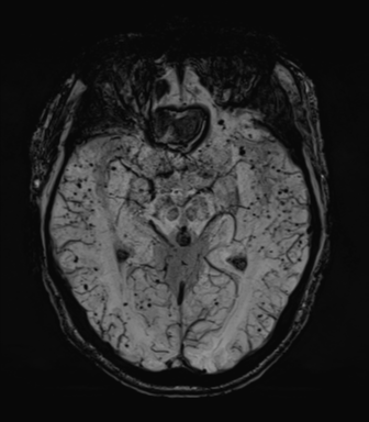 File:Cerebral amyloid angiopathy (Radiopaedia 46082-50433 Axial SWI MIP 33).png
