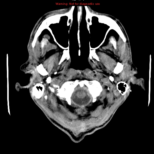 File:Cerebral and orbital tuberculomas (Radiopaedia 13308-13310 Axial non-contrast 2).jpg