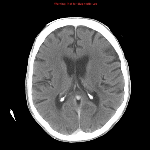 File:Cerebral and orbital tuberculomas (Radiopaedia 13308-13310 B 17).jpg