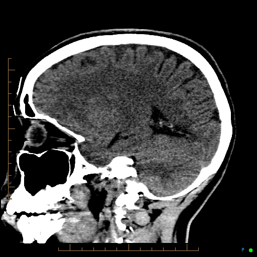 Cerebral arteriovenous malformation (AVM) (Radiopaedia 78162-90706 A 51).jpg