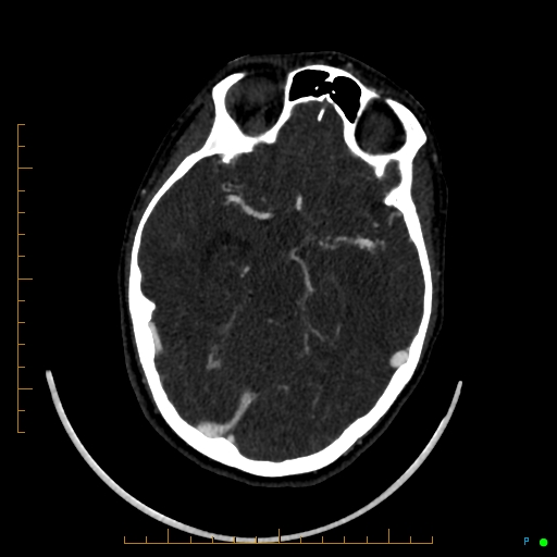 Cerebral arteriovenous malformation (AVM) (Radiopaedia 78162-90706 Axial CTA 117).jpg