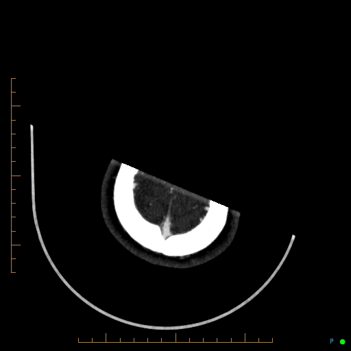 Cerebral arteriovenous malformation (AVM) (Radiopaedia 78162-90706 Axial CTA 248).jpg