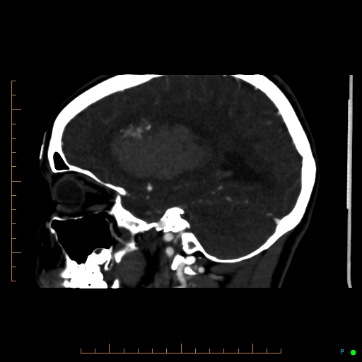 File:Cerebral arteriovenous malformation (AVM) (Radiopaedia 78162-90706 Sagittal CTA 29).jpg