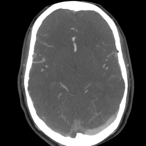 Cerebral arteriovenous malformation (Radiopaedia 39259-41505 AX CEREBRAL CTA 26).png