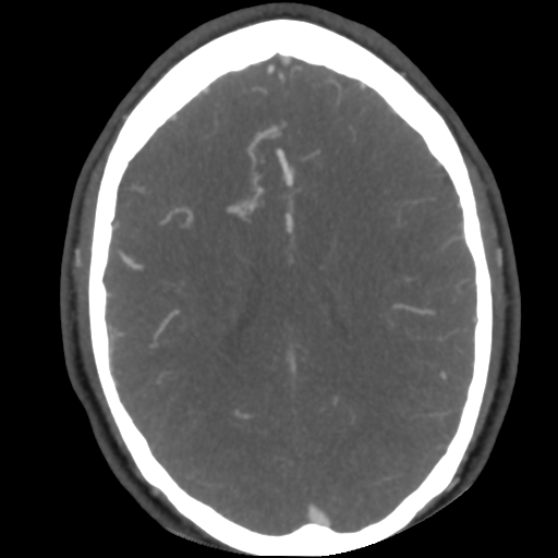 Cerebral arteriovenous malformation (Radiopaedia 39259-41505 AX CEREBRAL CTA 36).png