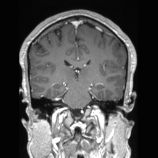 Cerebral arteriovenous malformation (Radiopaedia 39259-41506 Coronal T1 C+ 43).png