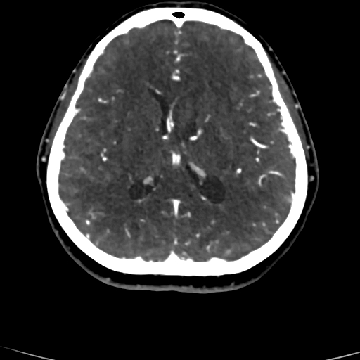 Cerebral arteriovenous malformation (Radiopaedia 73830-84645 Axial C+ delayed 40).jpg