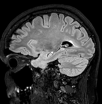 Cerebral arteriovenous malformation (Radiopaedia 74411-85746 Sagittal FLAIR 35).jpg