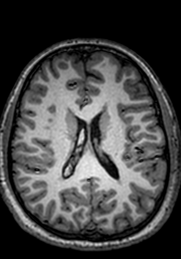 File:Cerebral arteriovenous malformation at posterior body of corpus callosum (Radiopaedia 74111-84925 Axial T1 114).jpg