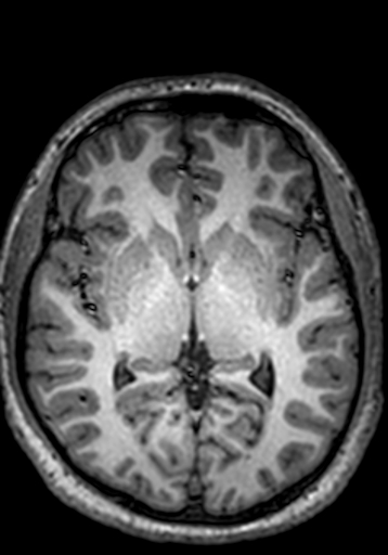 Cerebral arteriovenous malformation at posterior body of corpus callosum (Radiopaedia 74111-84925 Axial T1 151).jpg