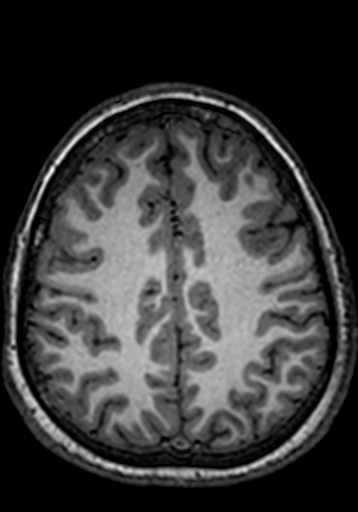 Cerebral arteriovenous malformation at posterior body of corpus callosum (Radiopaedia 74111-84925 Axial T1 76).jpg