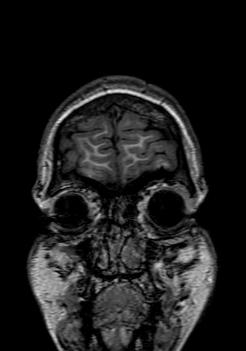 Cerebral arteriovenous malformation at posterior body of corpus callosum (Radiopaedia 74111-84925 Coronal T1 2).jpg
