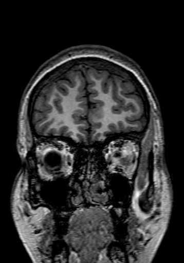 Cerebral arteriovenous malformation at posterior body of corpus callosum (Radiopaedia 74111-84925 Coronal T1 31).jpg