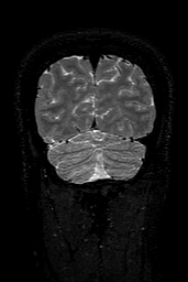 Cerebral arteriovenous malformation at posterior body of corpus callosum (Radiopaedia 74111-84925 Coronal T2 155).jpg