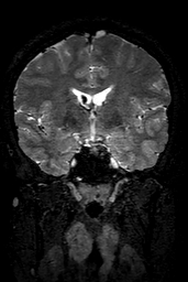 Cerebral arteriovenous malformation at posterior body of corpus callosum (Radiopaedia 74111-84925 Coronal T2 77).jpg