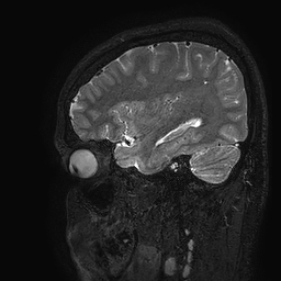 Cerebral arteriovenous malformation at posterior body of corpus callosum (Radiopaedia 74111-84925 Sagittal T2 102).jpg