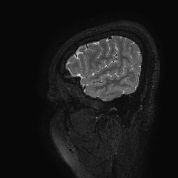 Cerebral arteriovenous malformation at posterior body of corpus callosum (Radiopaedia 74111-84925 Sagittal T2 126).jpg