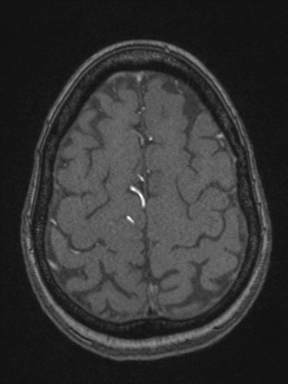 Cerebral arteriovenous malformation with hemorrhage (Radiopaedia 34422-35737 Axial MRA 70).png