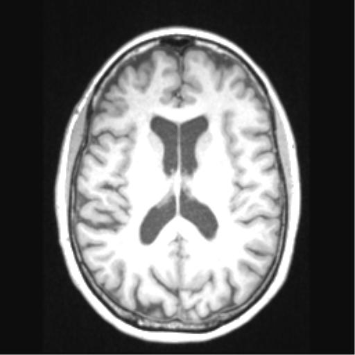 Cerebral arteriovenous malformation with hemorrhage (Radiopaedia 34422-35737 Axial T1 45).png