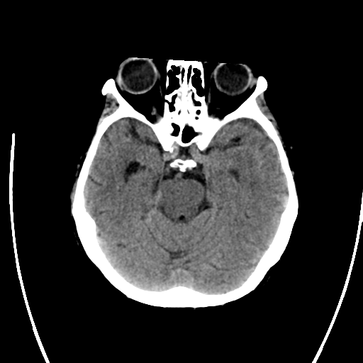 File:Cerebral arteriovenous malformation with lobar hemorrhage (Radiopaedia 44725-48512 Axial non-contrast 15).png