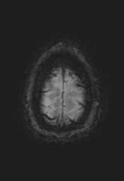 File:Cerebral cavernoma and development venous anomaly (Radiopaedia 37603-39482 Axial SWI 38).png