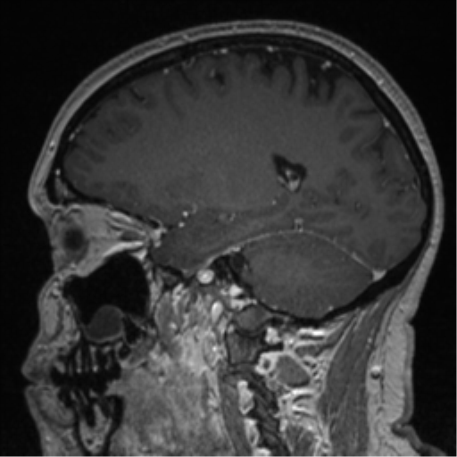 File:Cerebral cavernoma and development venous anomaly (Radiopaedia 37603-39482 Sagittal T1 C+ 37).png