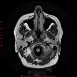 File:Cerebral cavernous malformation (Radiopaedia 26177-26306 FLAIR 3).jpg