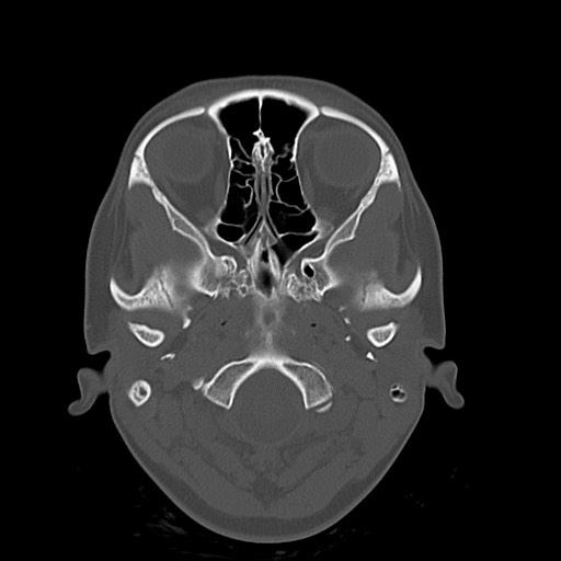 Cerebral cavernous venous malformation (Radiopaedia 70008-80022 Axial bone window 2).jpg