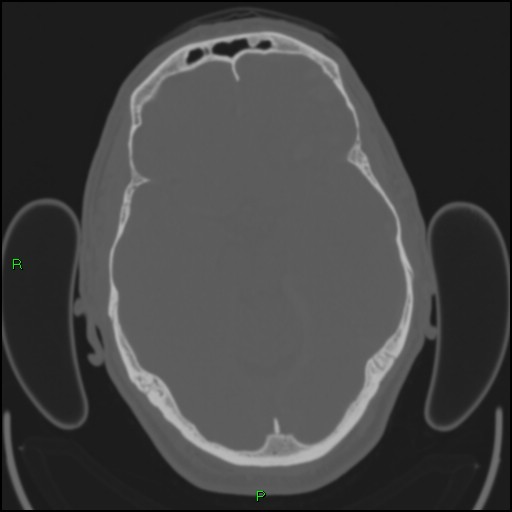 Cerebral contusions (Radiopaedia 33868-35039 Axial bone window 79).jpg