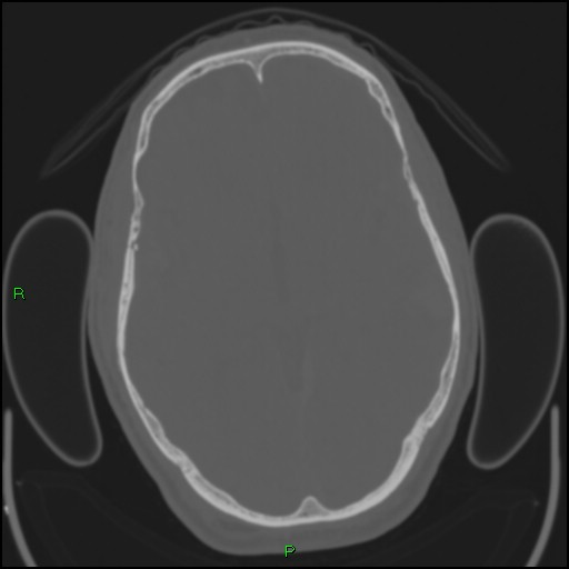 Cerebral contusions (Radiopaedia 33868-35039 Axial bone window 97).jpg
