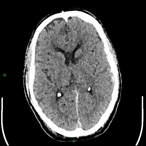 Cerebral contusions (Radiopaedia 33868-35039 Axial non-contrast 110).jpg