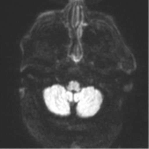 File:Cerebral embolic infarcts (embolic shower) (Radiopaedia 57395-64342 Axial DWI 42).png