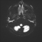 Cerebral embolic infarcts (embolic shower) (Radiopaedia 72391-82921 Axial DWI 32).jpg