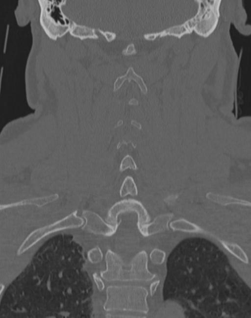 Cerebral hemorrhagic contusions and cervical spine fractures (Radiopaedia 32865-33841 Coronal bone window 50).jpg