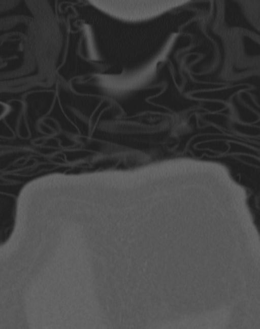 Cerebral hemorrhagic contusions and cervical spine fractures (Radiopaedia 32865-33841 Coronal bone window 98).jpg