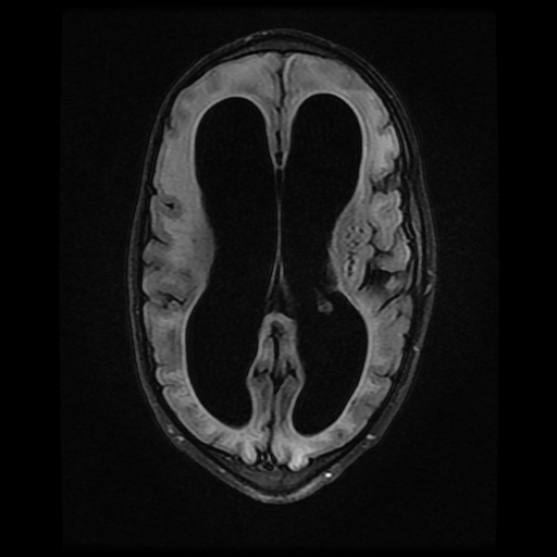 File:Cerebral manifestations of mucopolysaccharidosis type I (Radiopaedia 59171-66487 Axial FLAIR 12).jpg