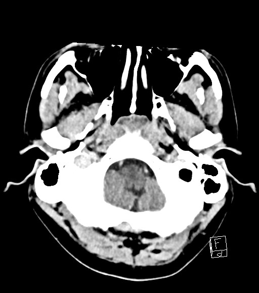Cerebral metastases - testicular choriocarcinoma (Radiopaedia 84486-99855 Axial C+ delayed 48).jpg