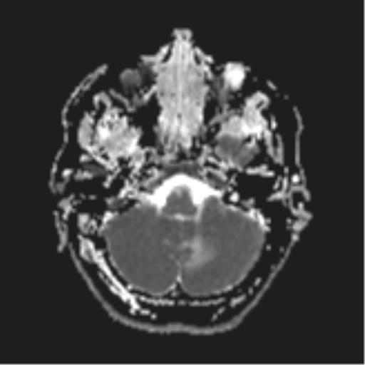 File:Cerebral metastases mimicking abscesses (Radiopaedia 45841-50131 Axial ADC 7).png